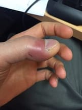 thumb infection spreading