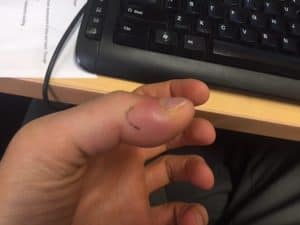infected thumb