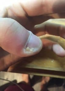 puss from infected finger